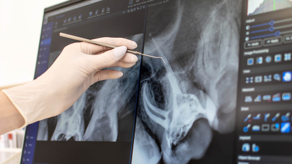 Endodoncija – Liječenje upale živca