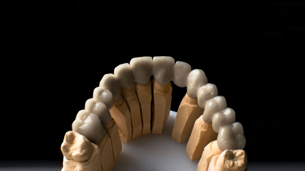 metal keramičke krunice u dental centru ostojić - akcija -20%