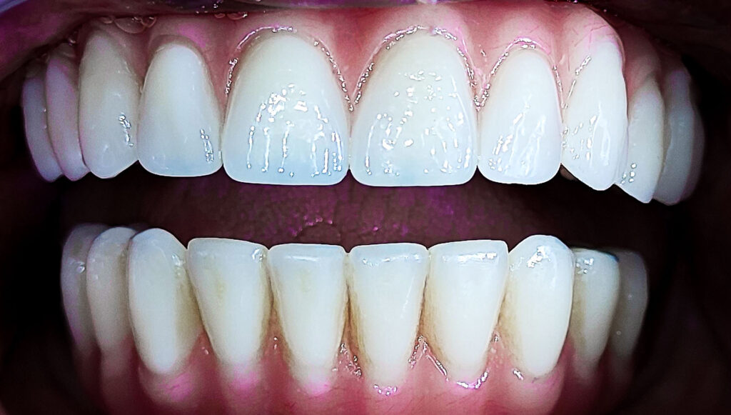 Subperiostalni implantati u dental centru ostojić - završni rad
