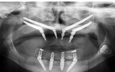 Akcija Zygoma implantati
